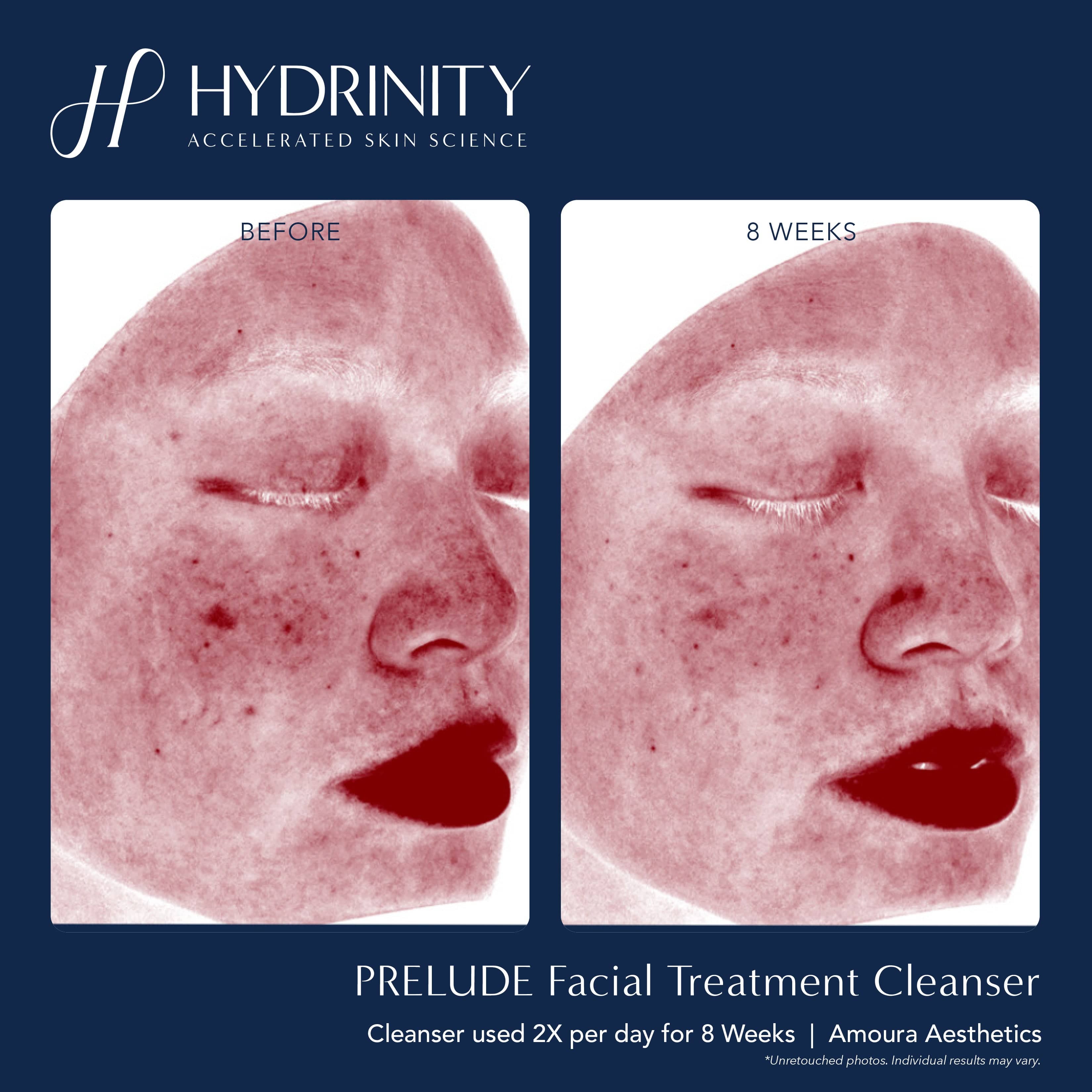 Hydrinity PRELUDE Facial Treatment Cleanser