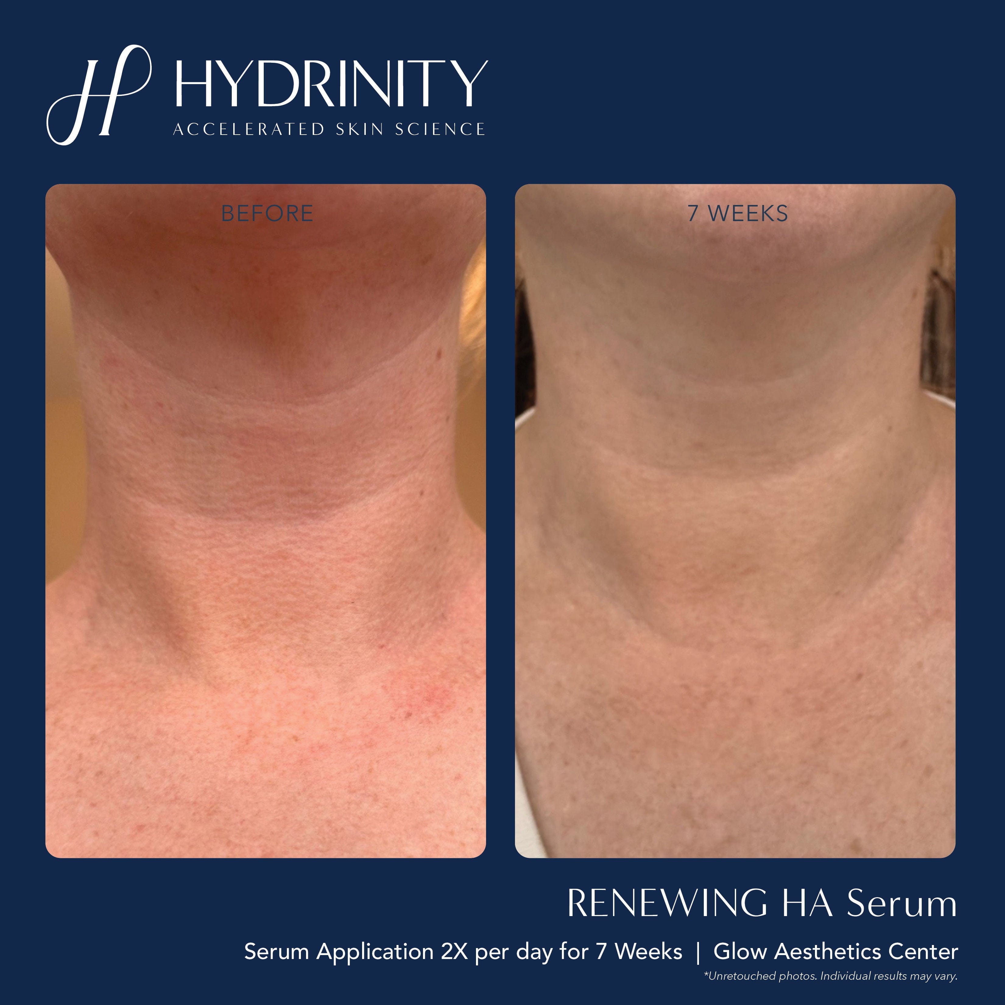 Hydrinity Renewing HA Serum