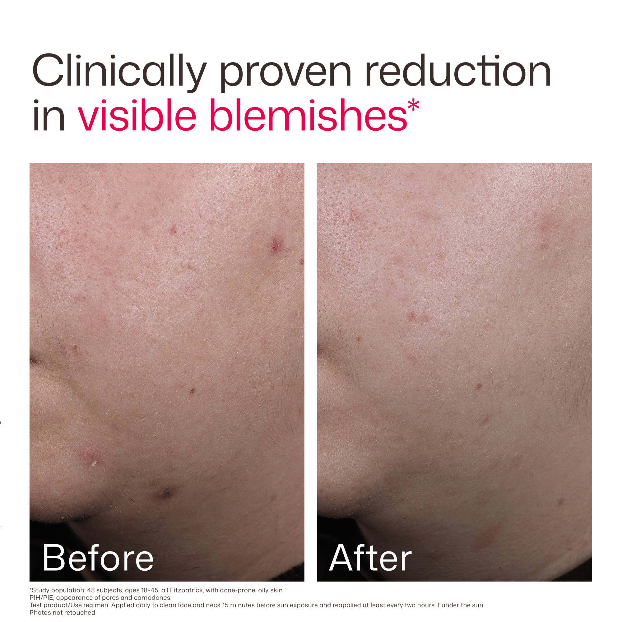 EltaMD UV Clear Acne Blemish-Prone & Oil Balancing SPF 50