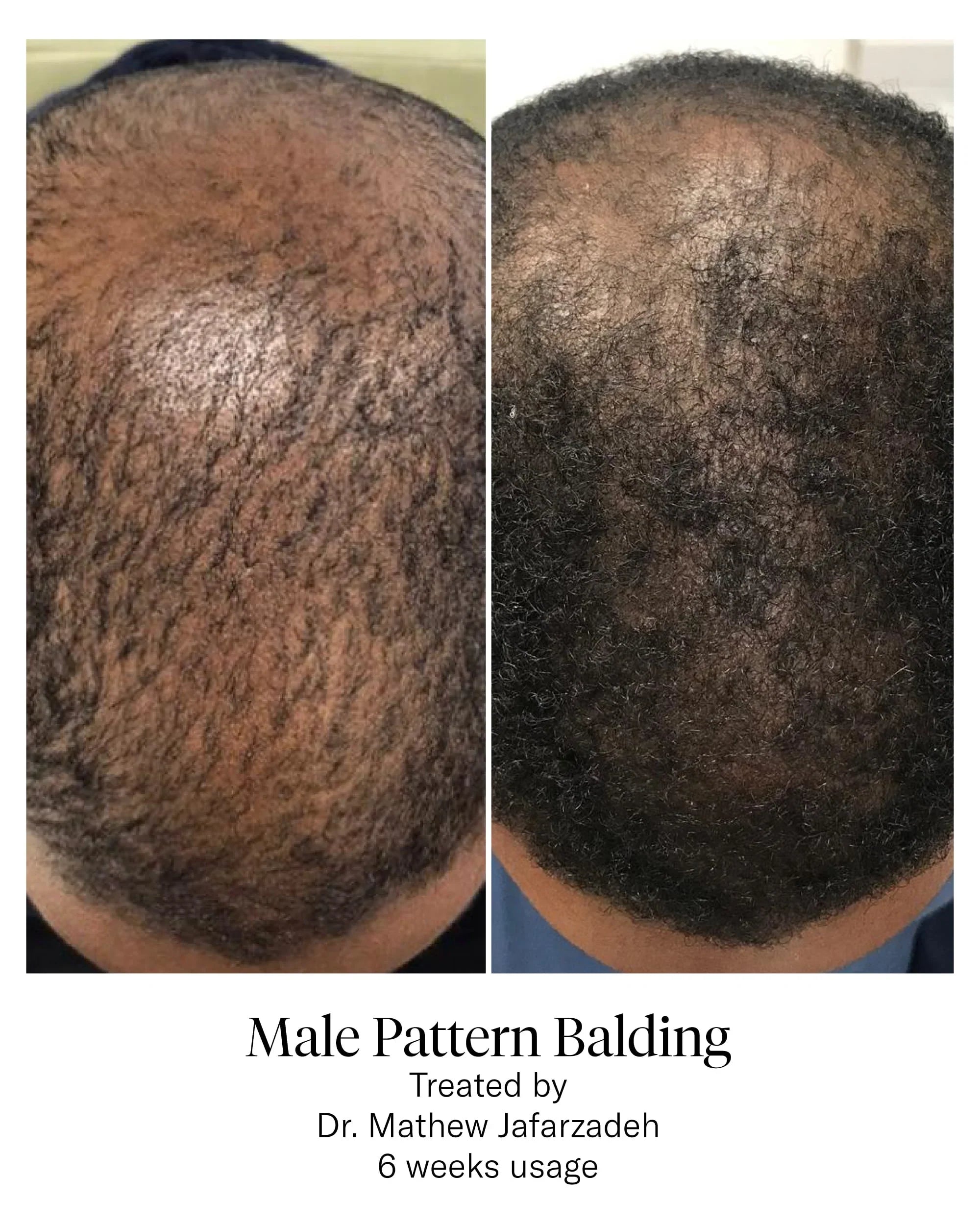 Calecim HAIR Serum