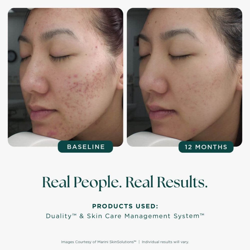 Marini Skin Solutions Duality Acne Treatment Cream
