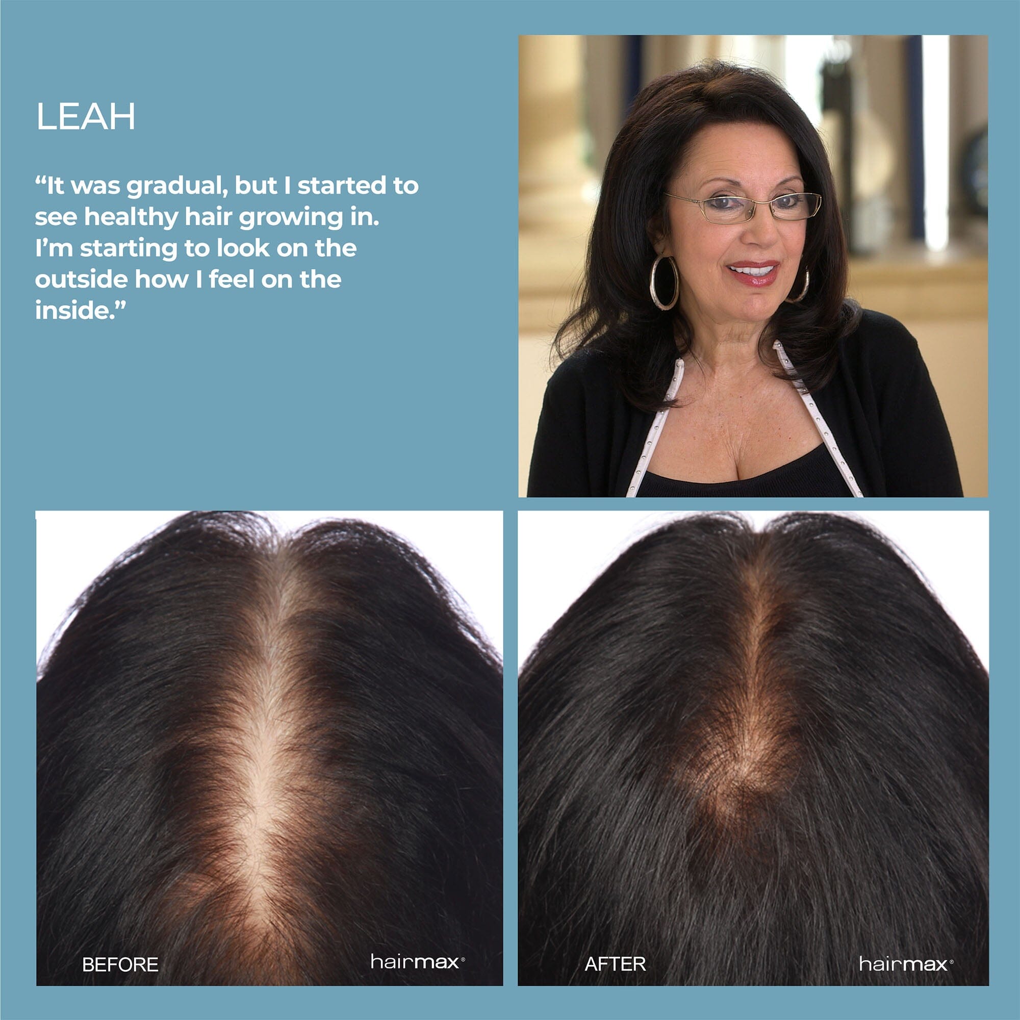 Hairmax Flip 80 Laser Hair Growth Cap