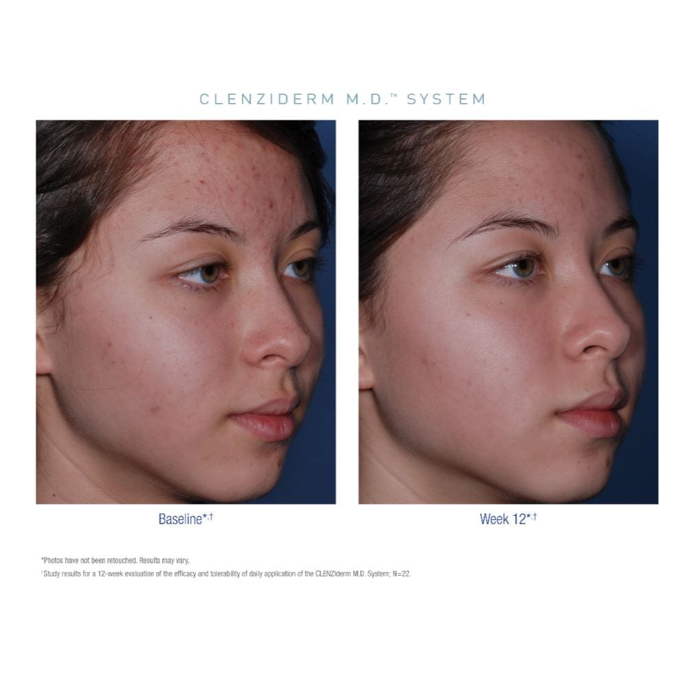Obagi CLENZIderm M.D. System