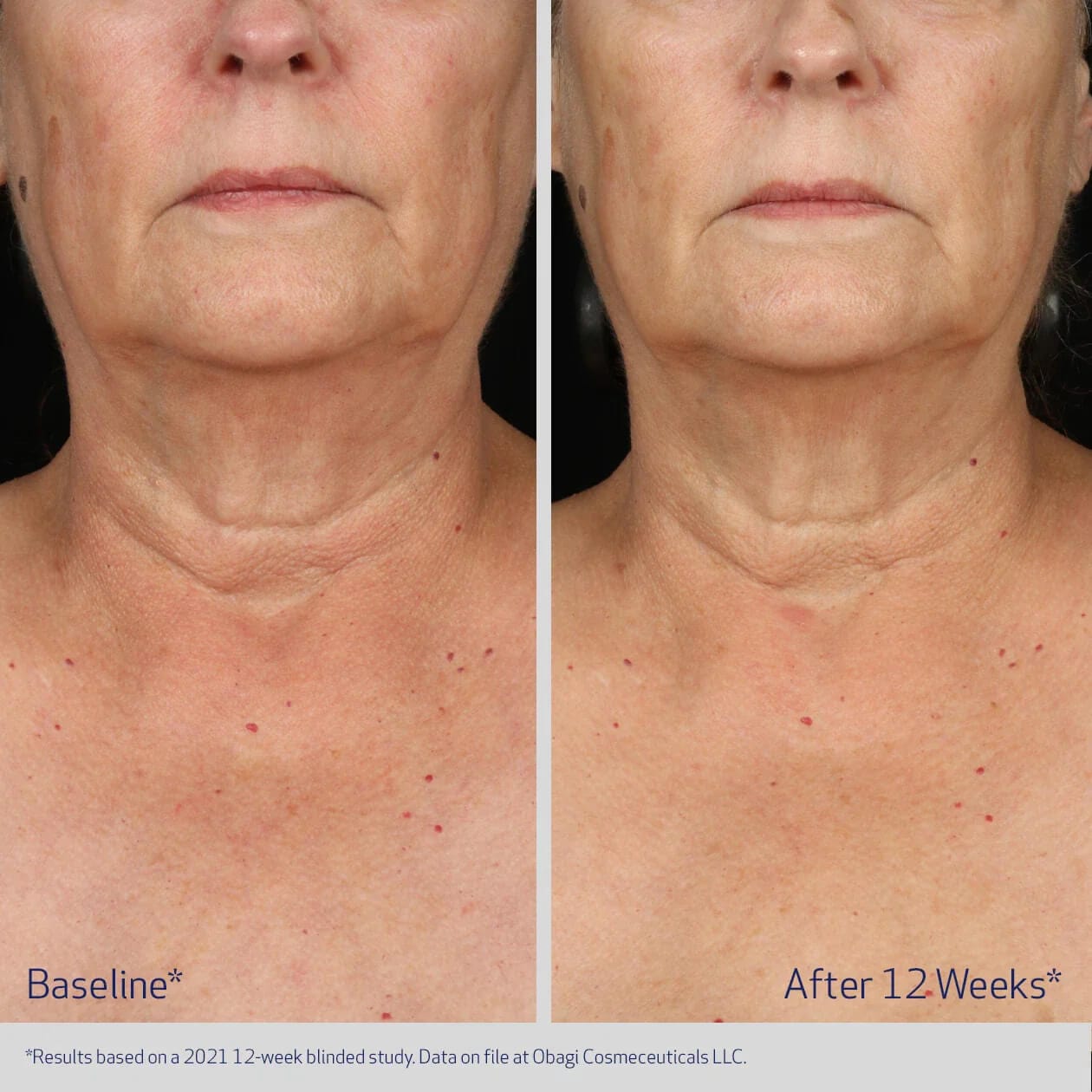 Obagi ELASTIderm Neck and Decollete Concentrate