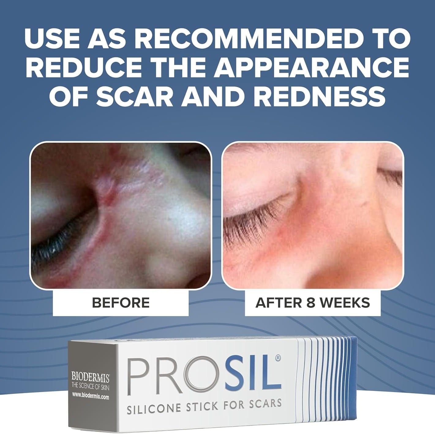 PROSIL Silicone Scar Stick