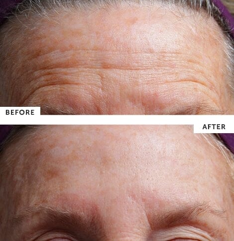 SilcSkin Facial Pads (Brow Set)