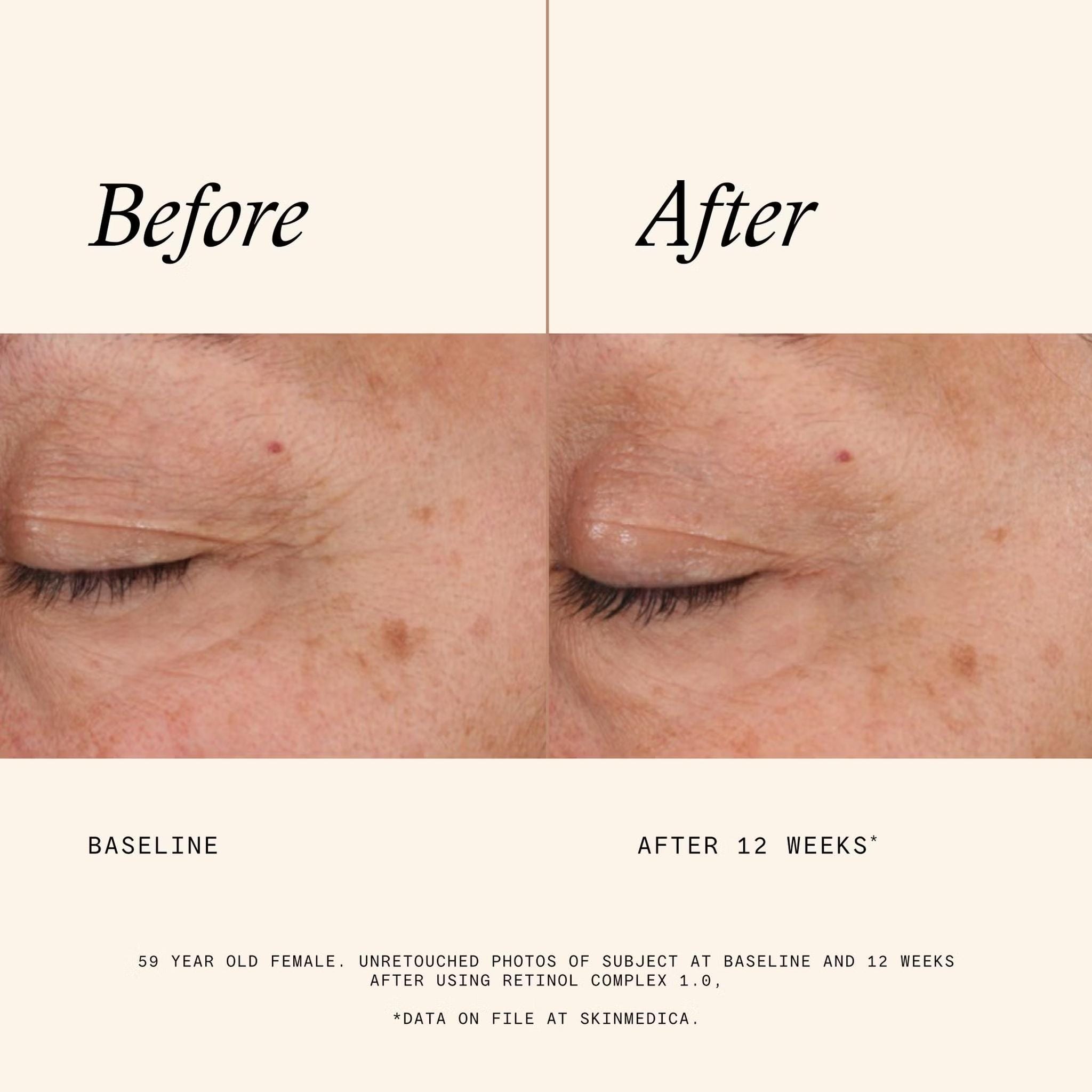 SkinMedica Age Defense Retinol Complex 1.0