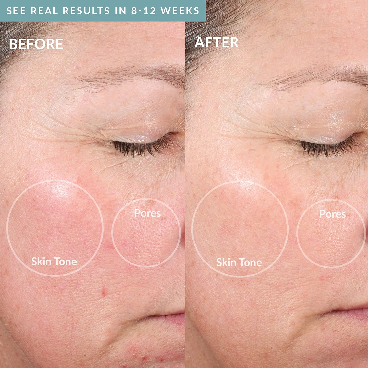 PMD Personal Microderm Elite Pro