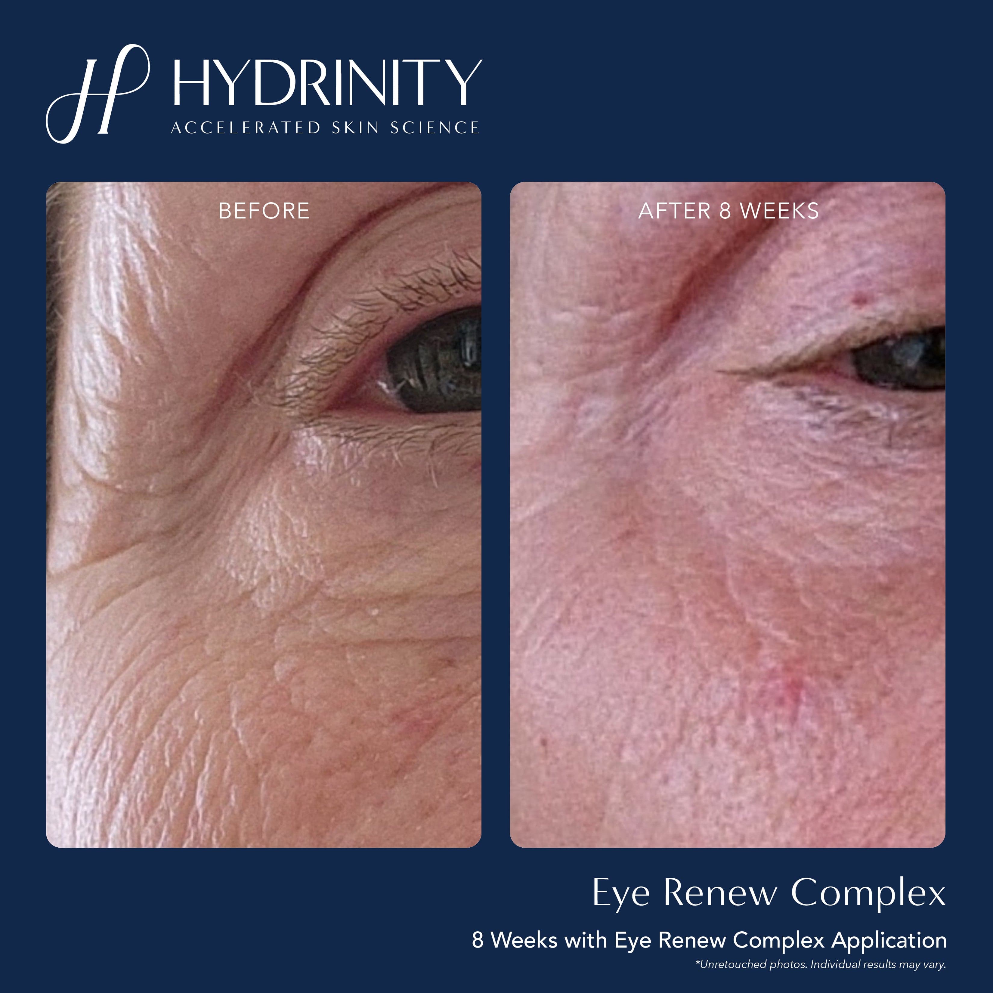Hydrinity Eye Renew Complex