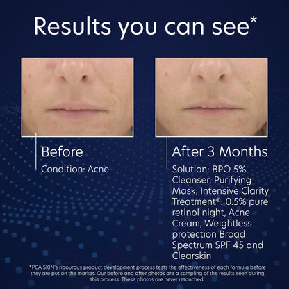 PCA Skin BPO 5% Cleanser