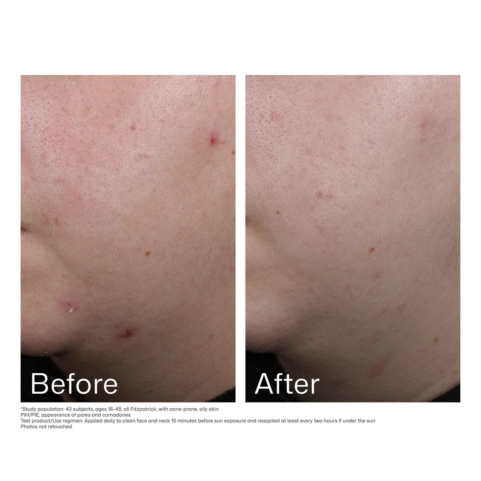 EltaMD® UV Clear Blemish-Prone & Oil Balancing SPF 50  - 1.7 fl. oz. / 48 g