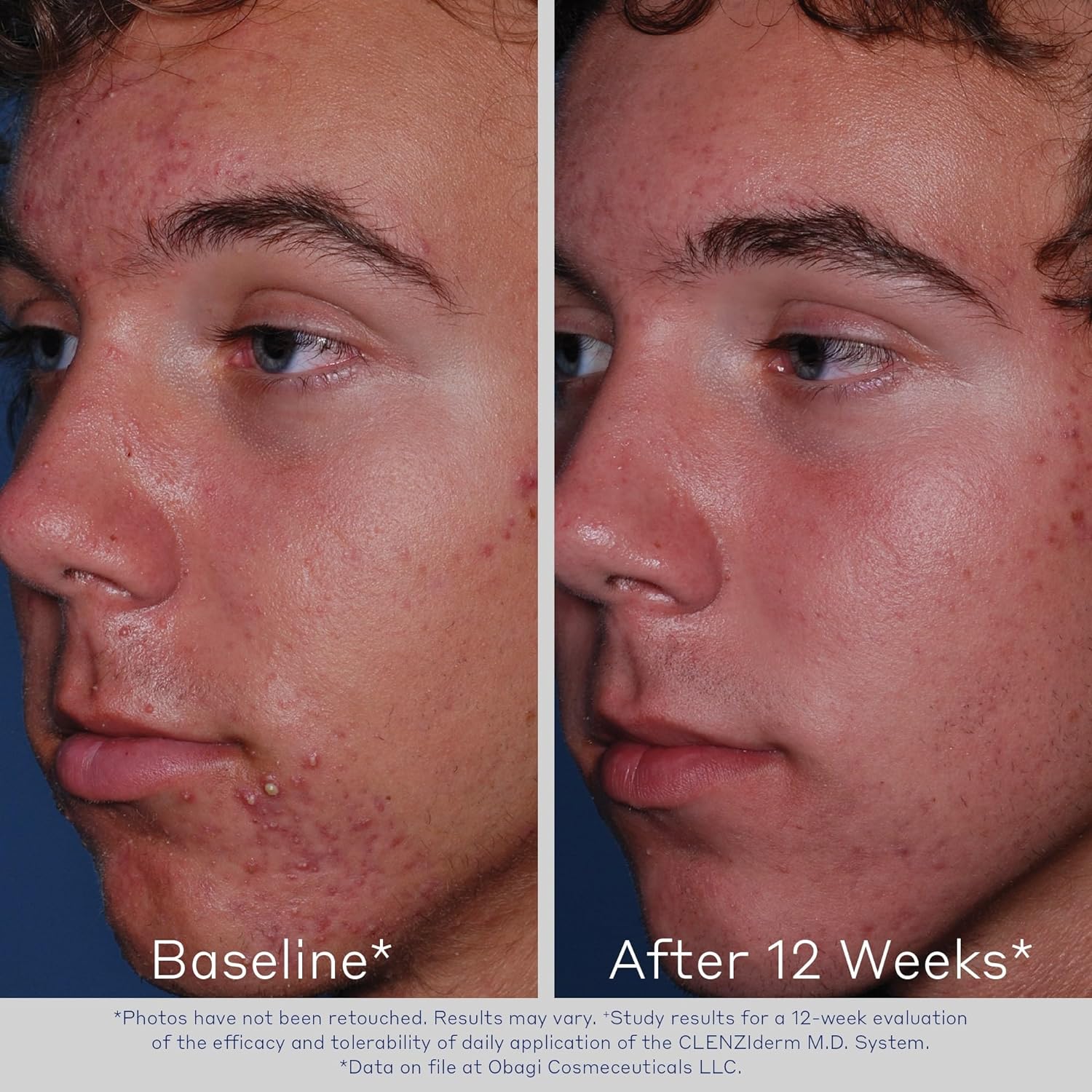 Obagi CLENZIderm M.D. Pore Therapy