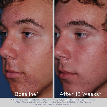 Obagi CLENZIderm M.D. Pore Therapy