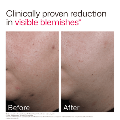 EltaMD UV Clear Acne Blemish-Prone & Oil Balancing SPF 50