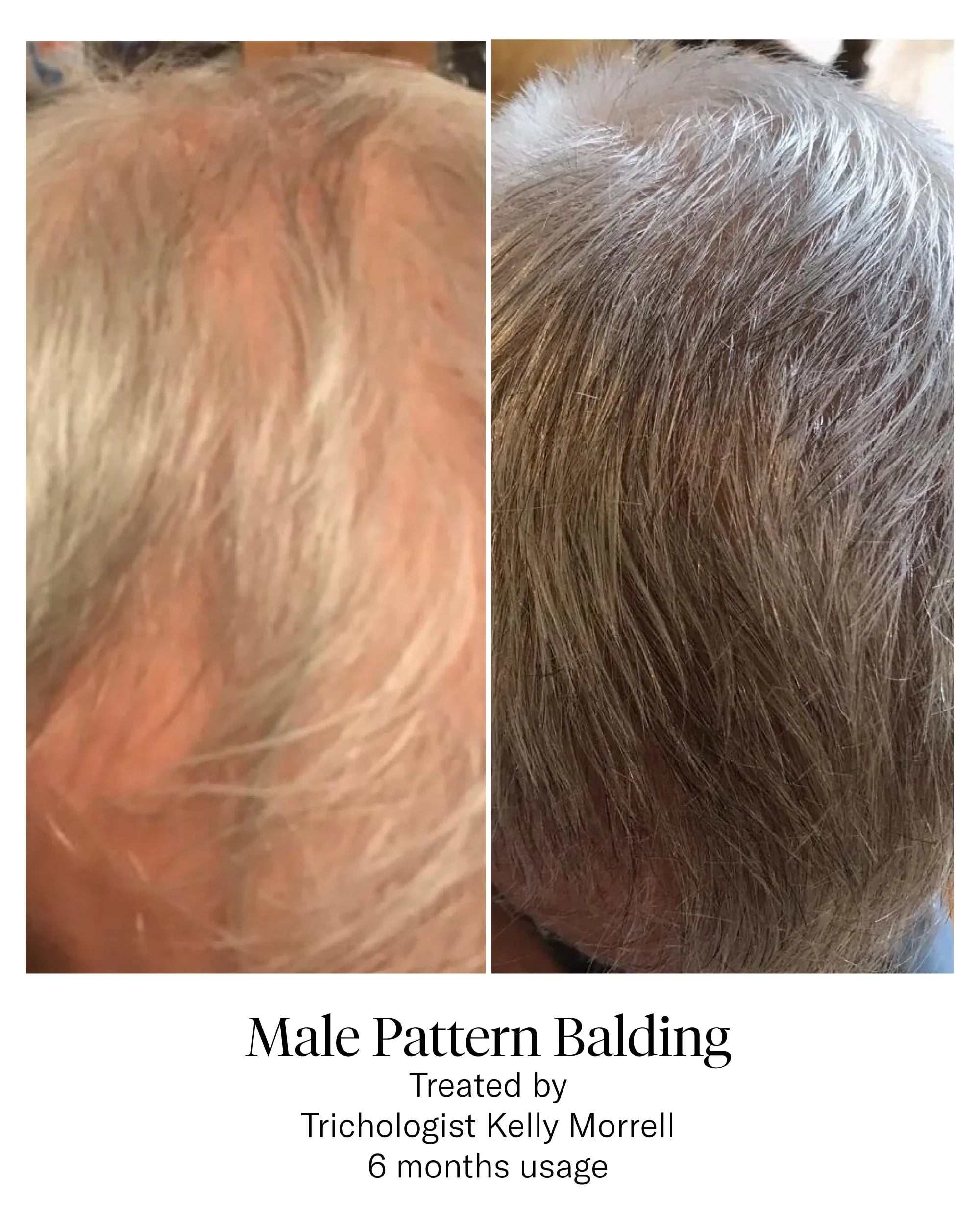 Calecim HAIR Serum
