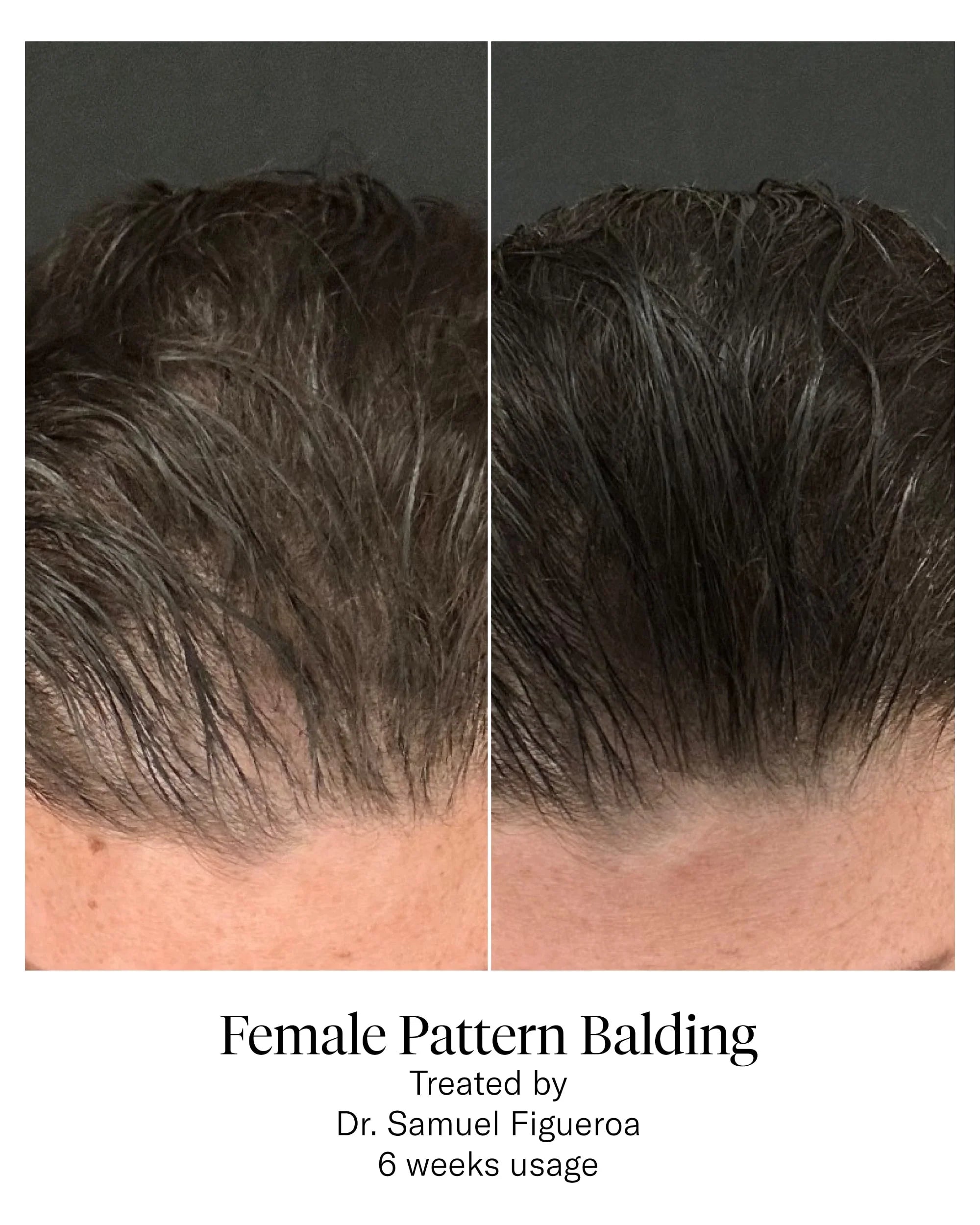Calecim HAIR Serum