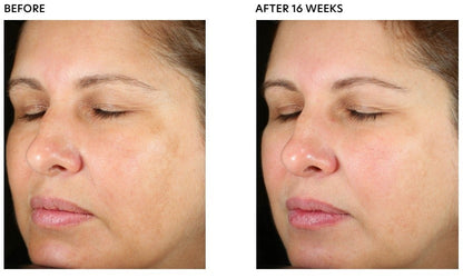 PCA Skin Pigment Gel® Pro