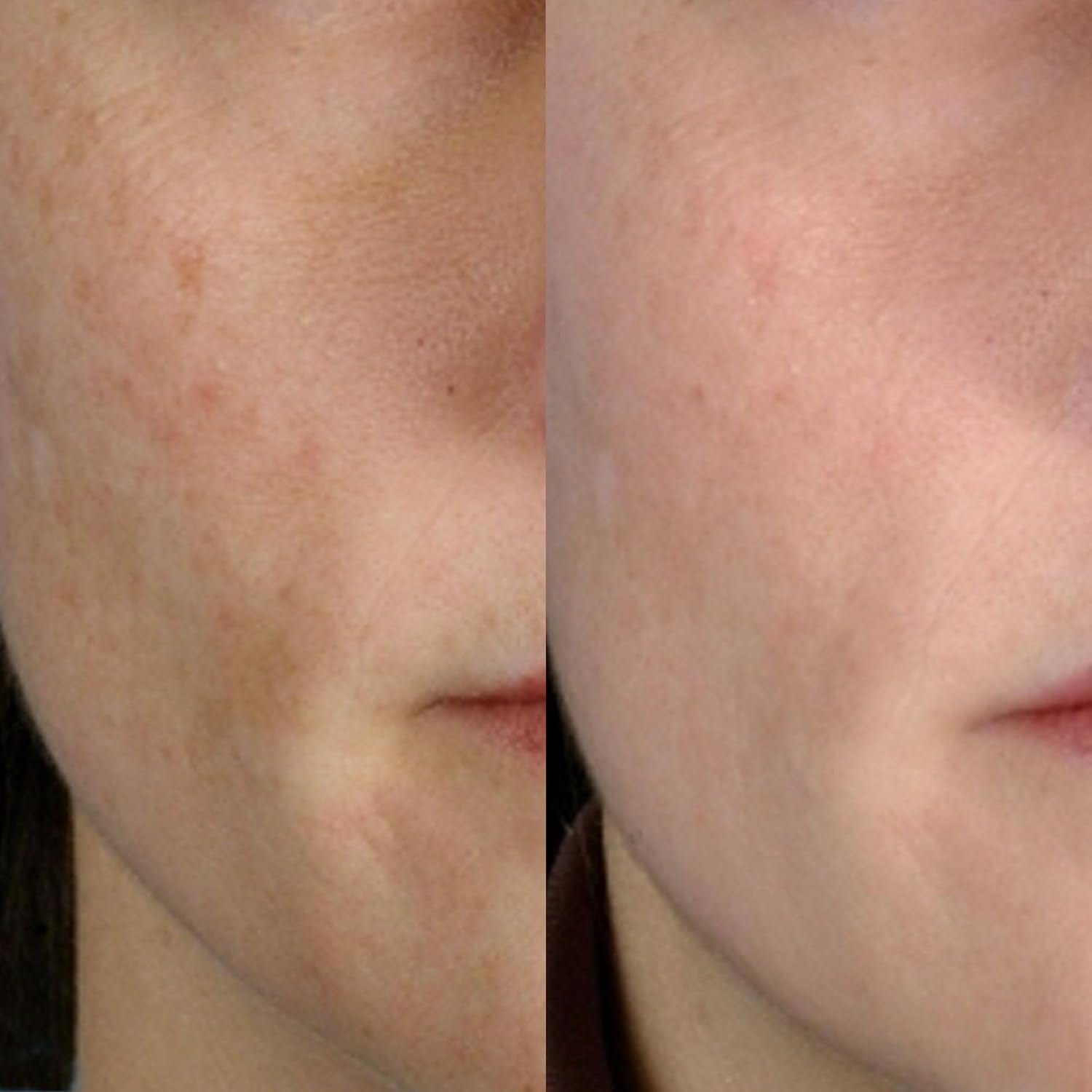 PMD Personal Microderm Classic