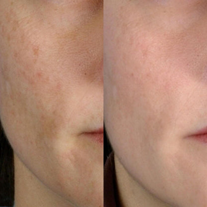 PMD Personal Microderm Classic