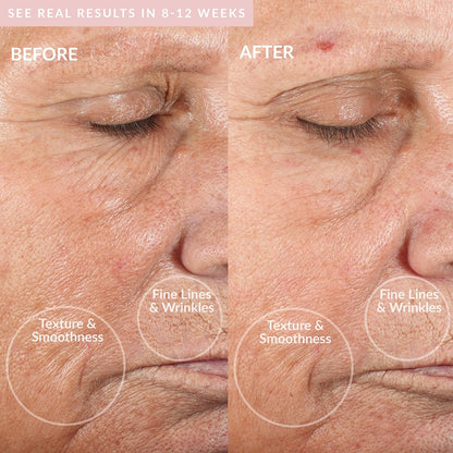 PMD Personal Microderm Classic