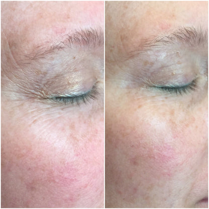 CO2Lift PRO Carboxy Gel Treatment