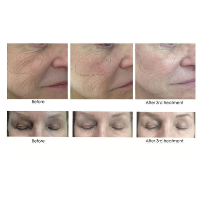 CO2Lift PRO Carboxy Gel Treatment