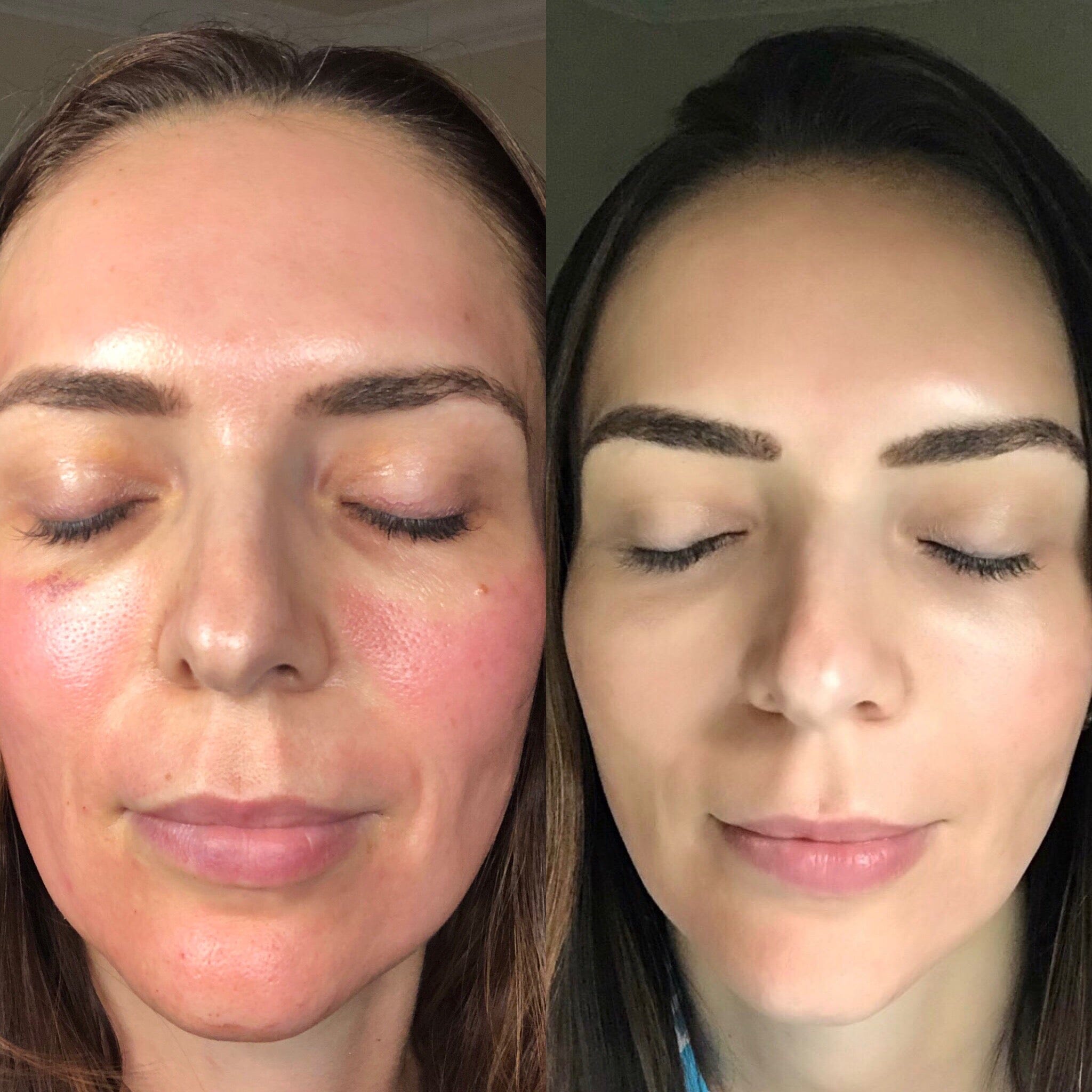 CO2Lift PRO Carboxy Gel Treatment