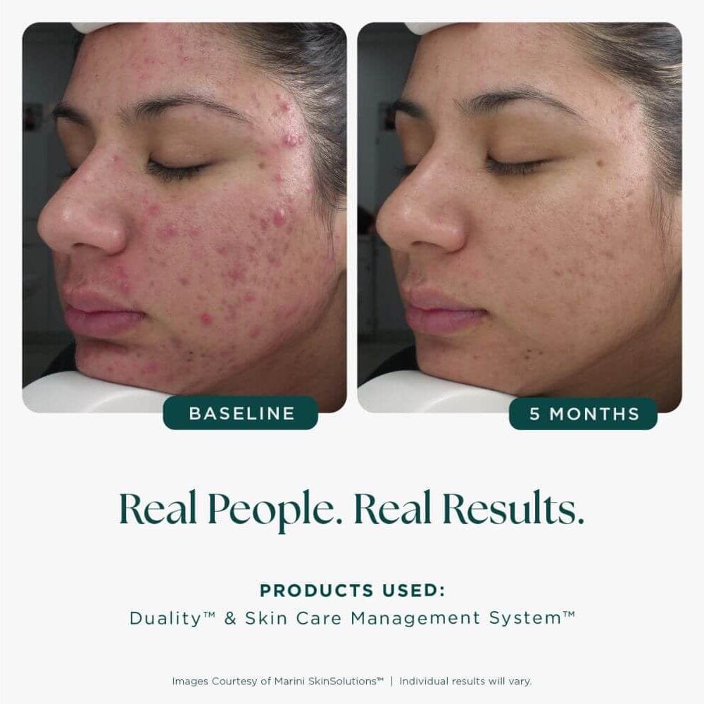 Marini Skin Solutions Duality Acne Treatment Cream