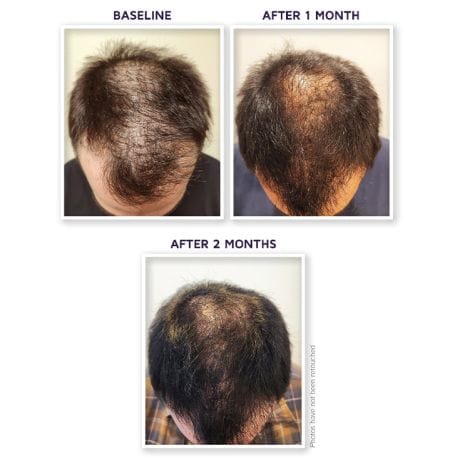 Defenage 150K Hair Follicle Serum for Scalp & Beard - Men's Edition