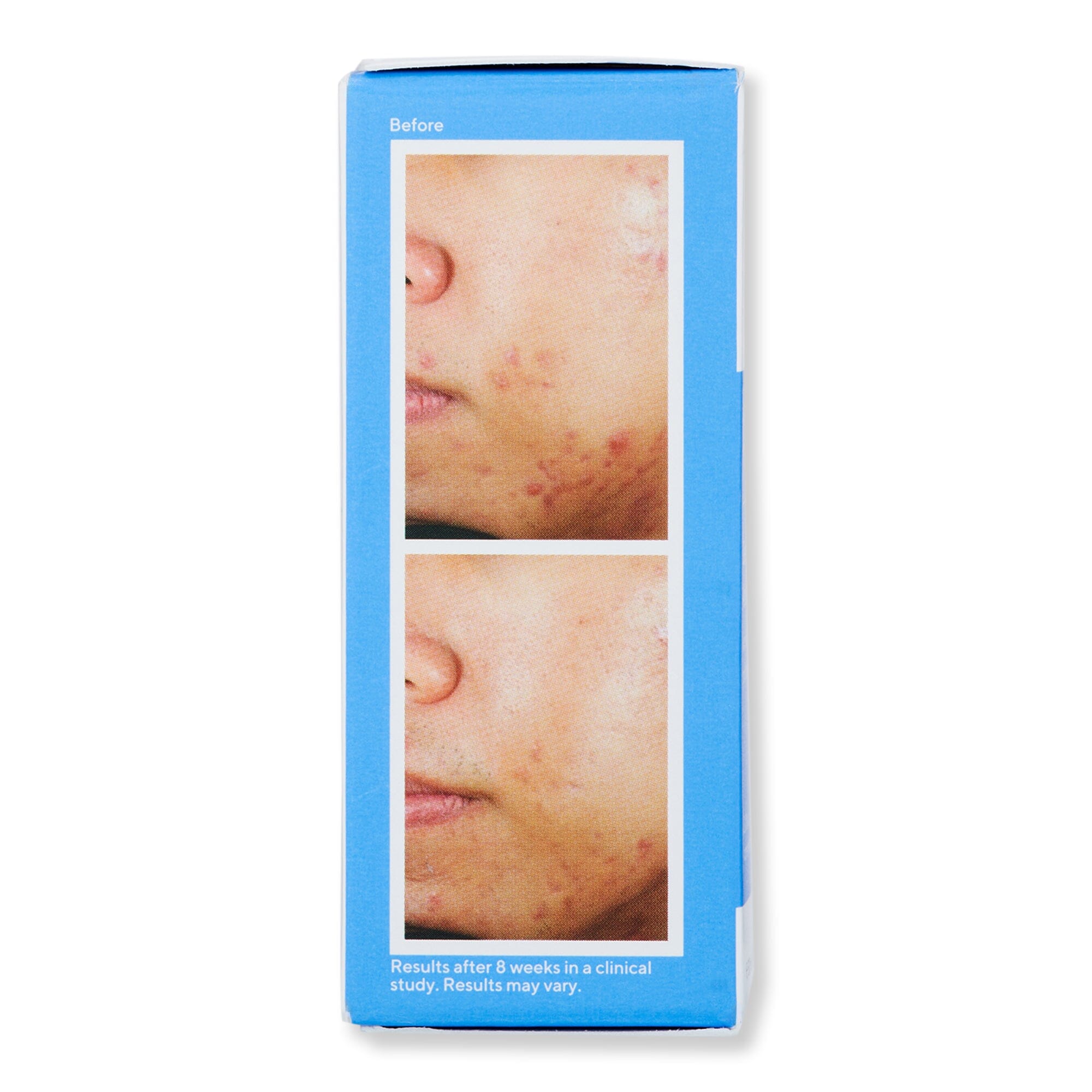Murad Deep Relief Acne Treatment