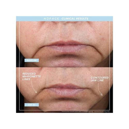 NuFACE TRINITY+ PRO Starter Kit