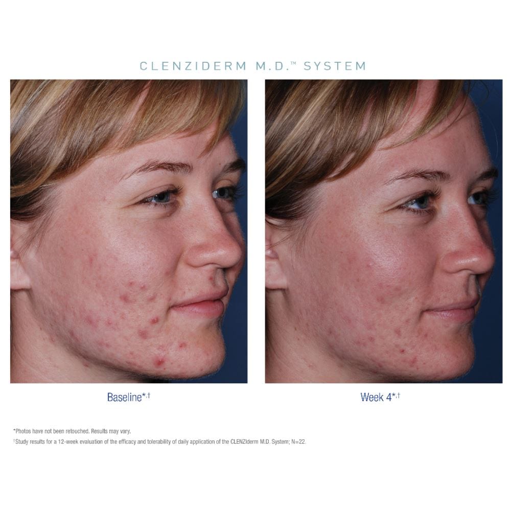 Obagi CLENZIderm M.D. System