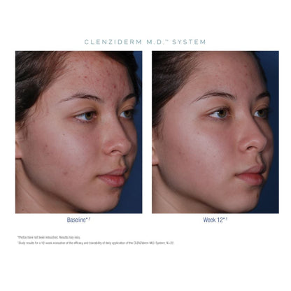 Obagi CLENZIderm M.D. System
