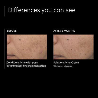PCA Skin Acne Cream