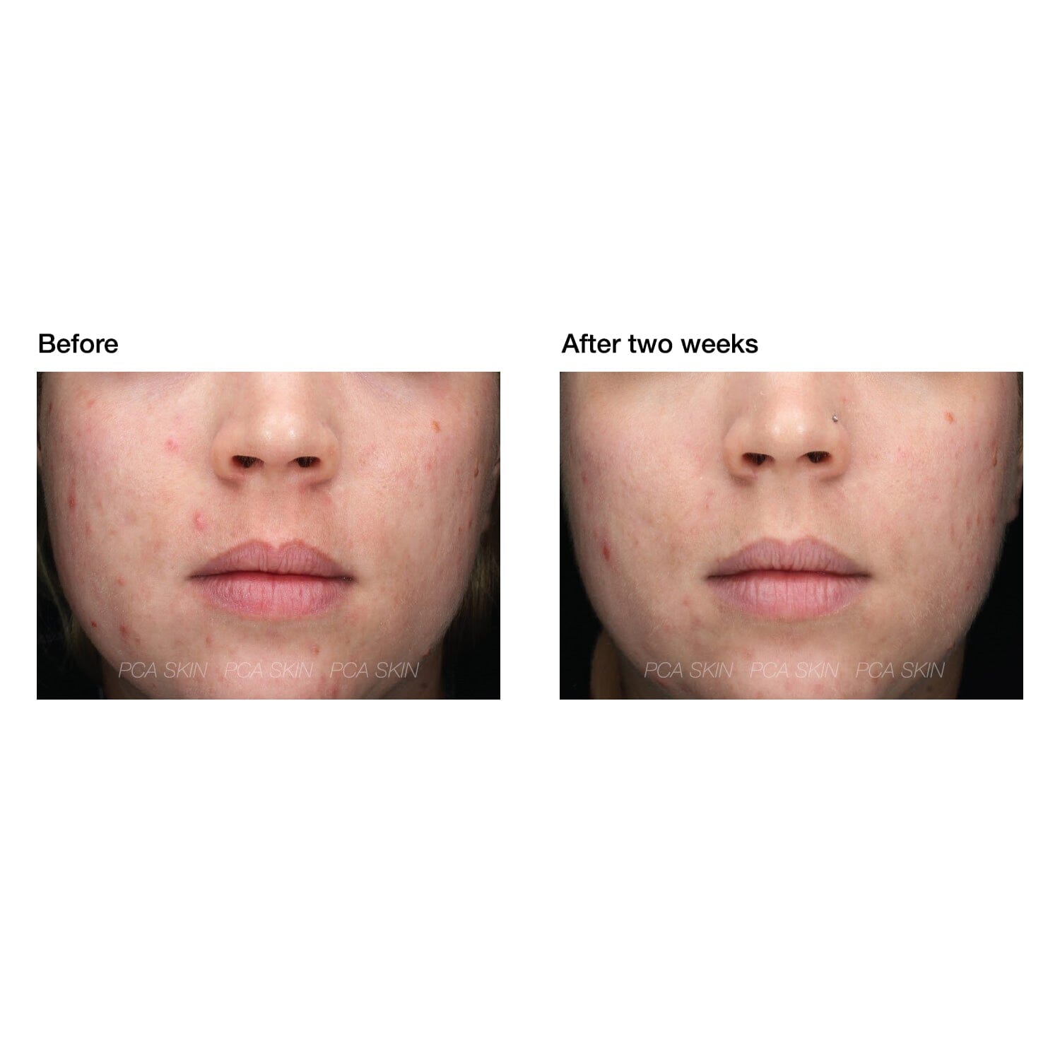 PCA Skin Acne Gel