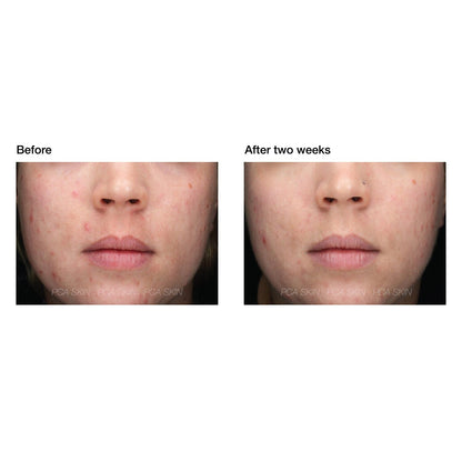 PCA Skin Acne Gel