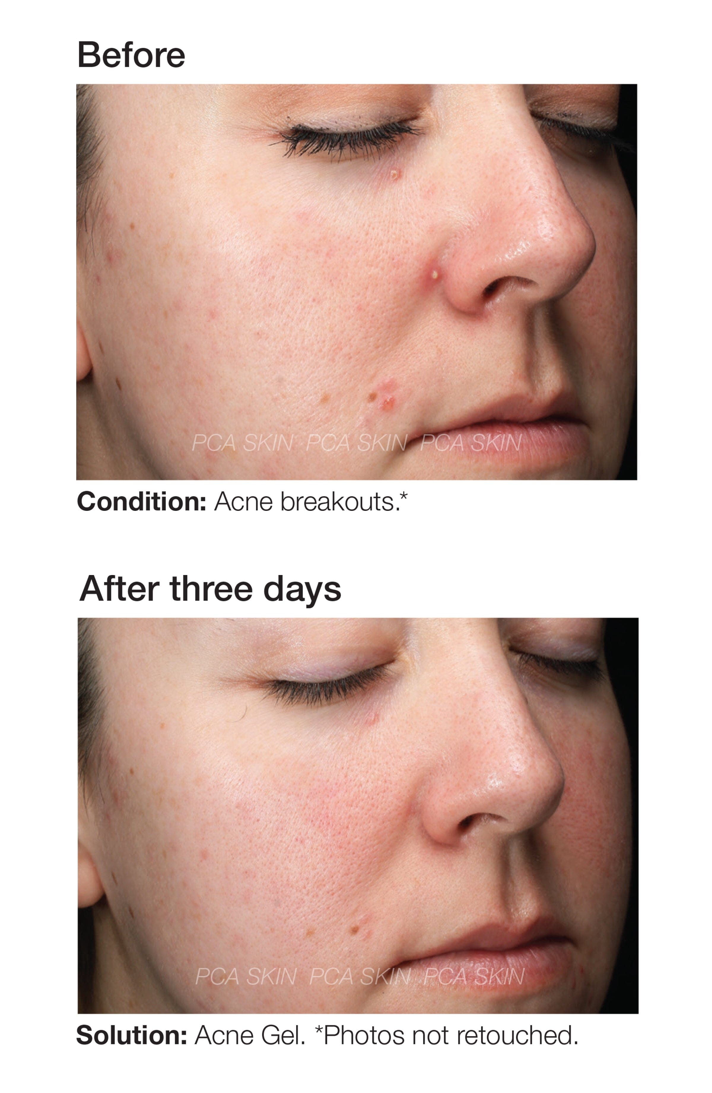 PCA Skin Acne Gel