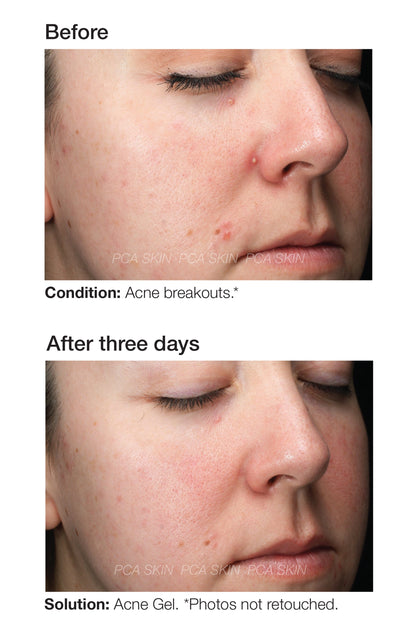 PCA Skin Acne Gel