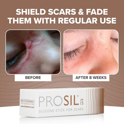 PROSIL Silicone Scar Stick SPF 15