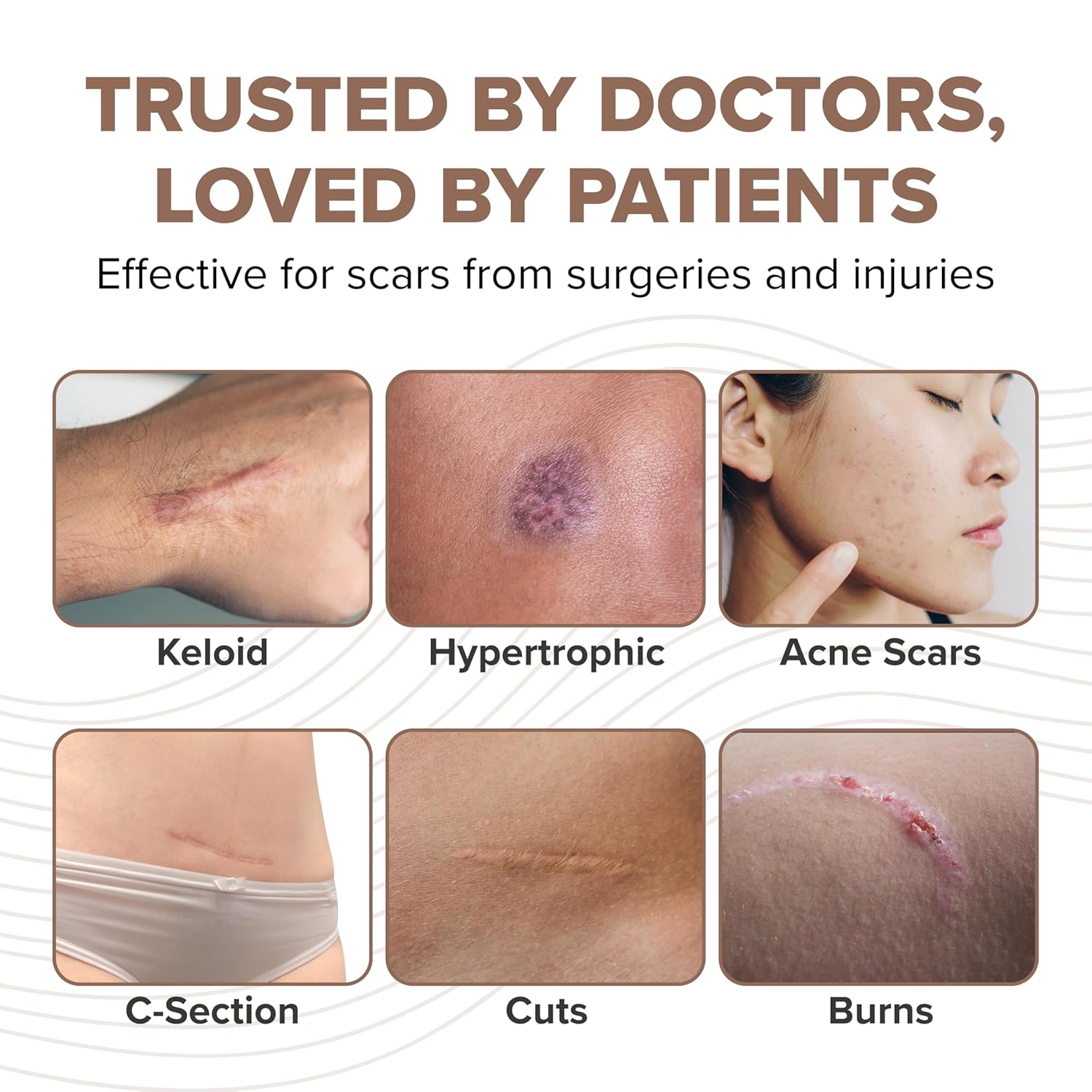 PROSIL Silicone Scar Stick SPF 15