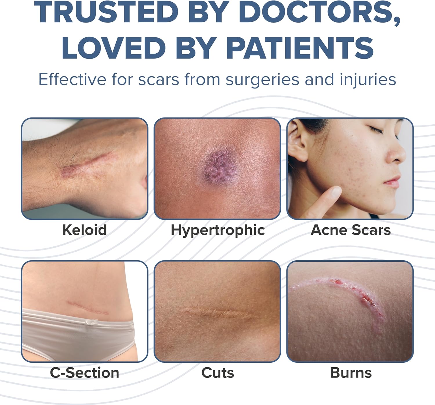 PROSIL Silicone Scar Stick