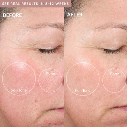 PMD Personal Microderm Elite Pro