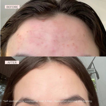 Yon-Ka Paris SOS SPOT Roll-On Blemish Treatment